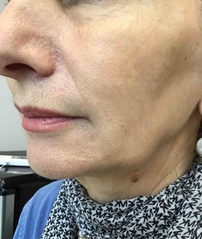 Laser Rejuvenation Before & After Gallery - Patient 409092 - Image 2