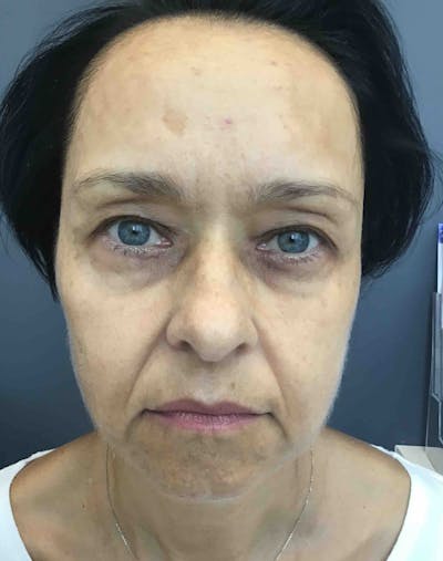 Laser Rejuvenation Before & After Gallery - Patient 220266 - Image 1