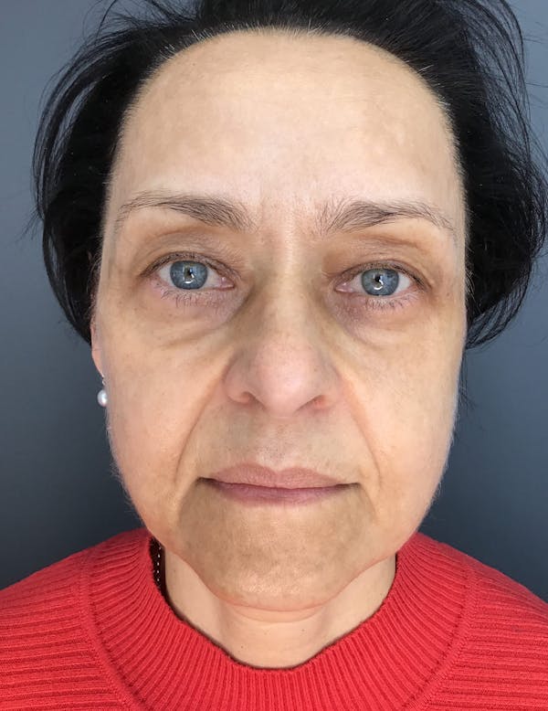 Laser Rejuvenation Before & After Gallery - Patient 220266 - Image 2