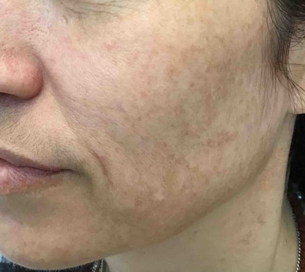 Laser Rejuvenation Before & After Gallery - Patient 138089 - Image 1