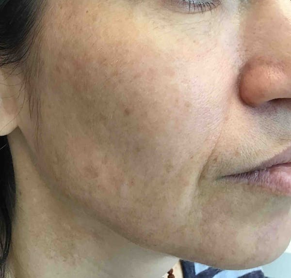 Laser Rejuvenation Before & After Gallery - Patient 138089 - Image 3