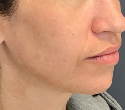 Laser Rejuvenation Before & After Gallery - Patient 138089 - Image 4