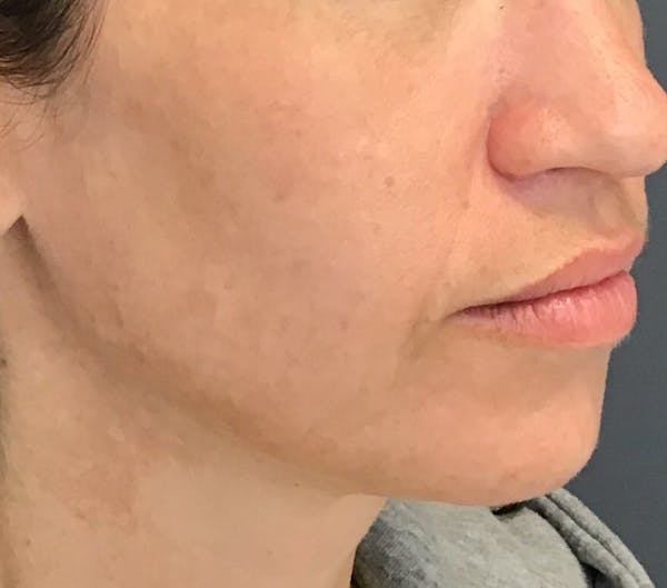 Laser Rejuvenation Before & After Gallery - Patient 138089 - Image 4