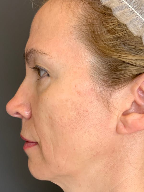 Liquid Facelift Before & After Gallery - Patient 888496 - Image 3