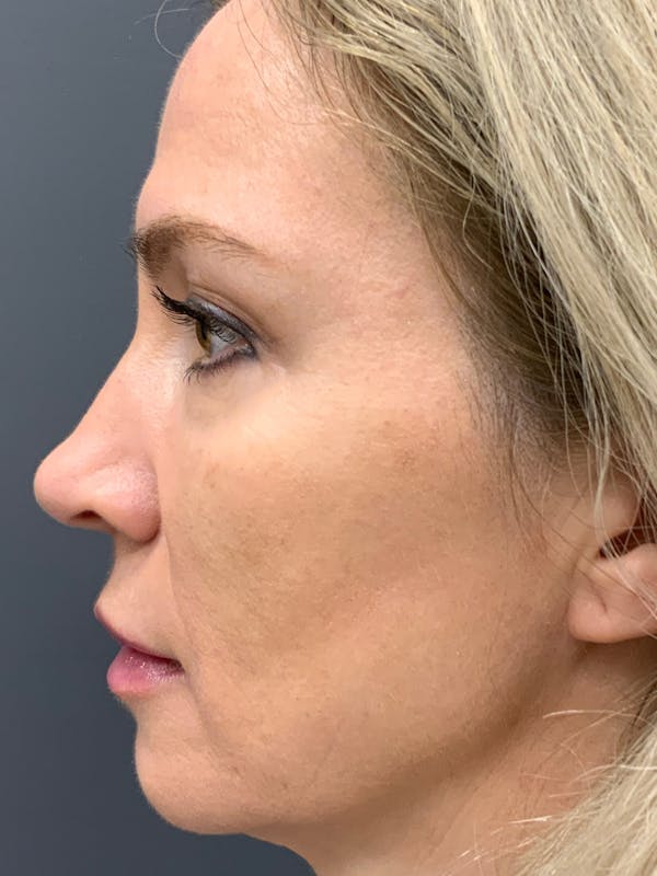 Liquid Facelift Before & After Gallery - Patient 888496 - Image 4