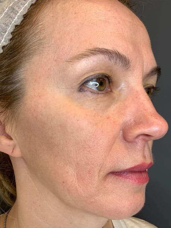 Liquid Facelift Before & After Gallery - Patient 888496 - Image 5