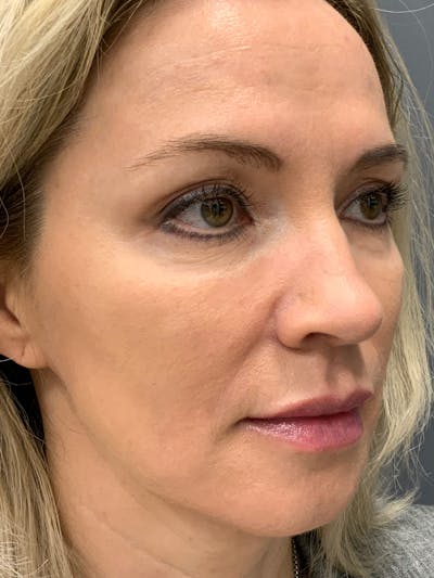 Liquid Facelift Before & After Gallery - Patient 888496 - Image 6