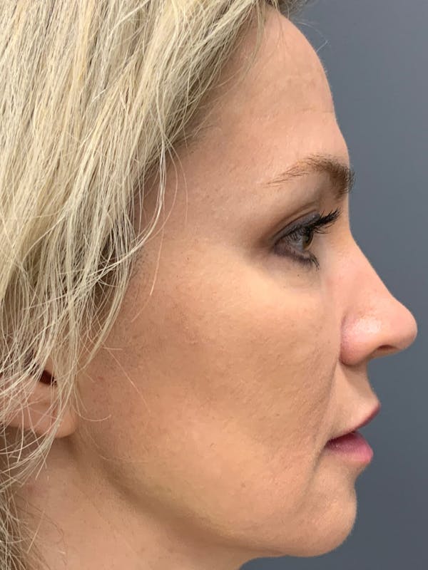 Liquid Facelift Before & After Gallery - Patient 888496 - Image 8
