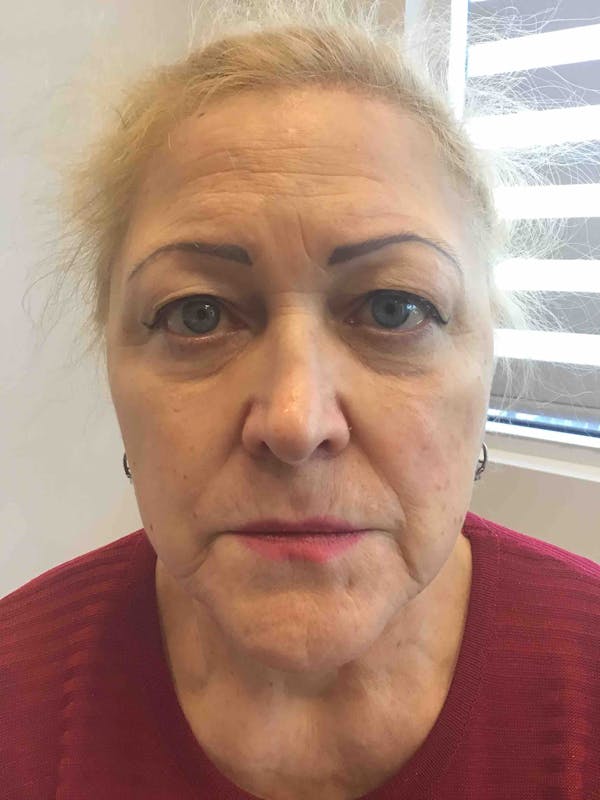 Liquid Facelift Before & After Gallery - Patient 625519 - Image 1