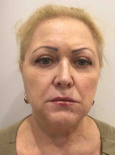 Liquid Facelift Before & After Gallery - Patient 625519 - Image 2