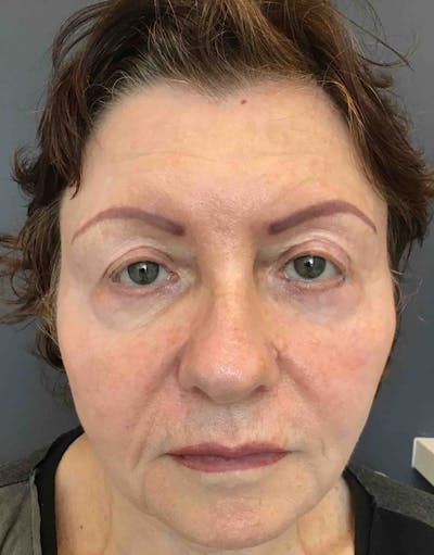 Liquid Facelift Before & After Gallery - Patient 194274 - Image 1