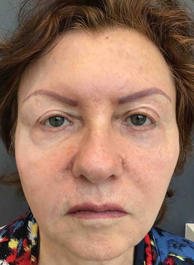 Liquid Facelift Before & After Gallery - Patient 194274 - Image 2