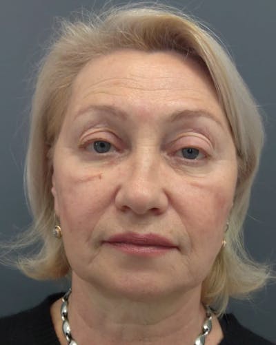 Liquid Facelift Before & After Gallery - Patient 339472 - Image 1