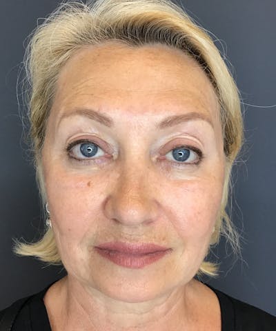 Liquid Facelift Before & After Gallery - Patient 339472 - Image 2