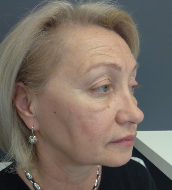 Liquid Facelift Before & After Gallery - Patient 339472 - Image 3