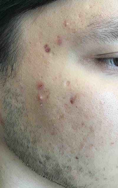 PRP / Microneedling Before & After Gallery - Patient 139338 - Image 1