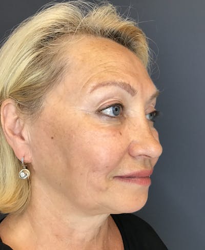 Liquid Facelift Before & After Gallery - Patient 339472 - Image 4