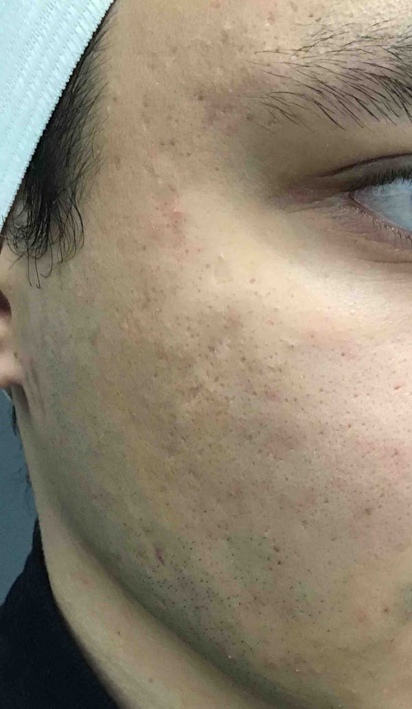 PRP / Microneedling Before & After Gallery - Patient 139338 - Image 2