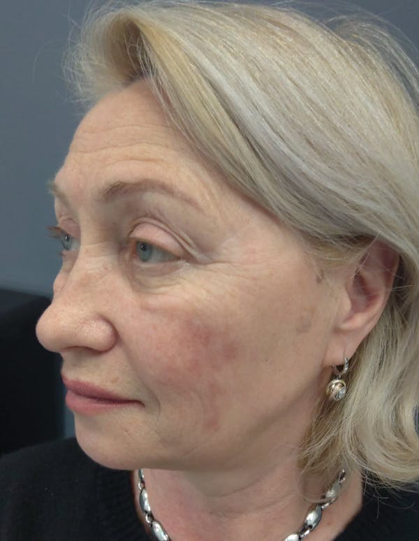 Liquid Facelift Before & After Gallery - Patient 339472 - Image 5