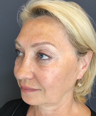 Liquid Facelift Before & After Gallery - Patient 339472 - Image 6