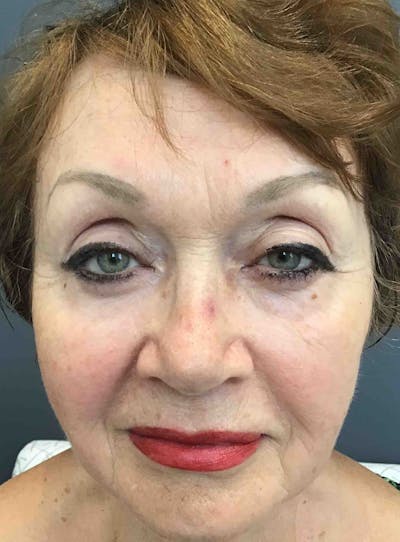 Liquid Facelift Before & After Gallery - Patient 116599 - Image 1