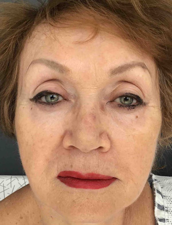 Liquid Facelift Before & After Gallery - Patient 116599 - Image 2