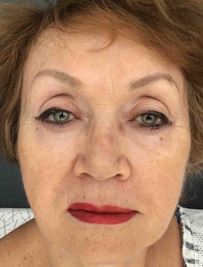 Liquid Facelift Before & After Gallery - Patient 116599 - Image 2