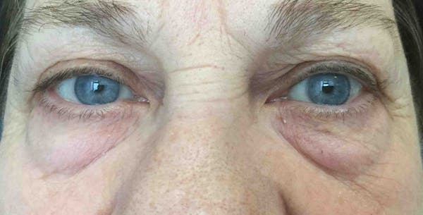 Liquid Facelift Before & After Gallery - Patient 356151 - Image 3