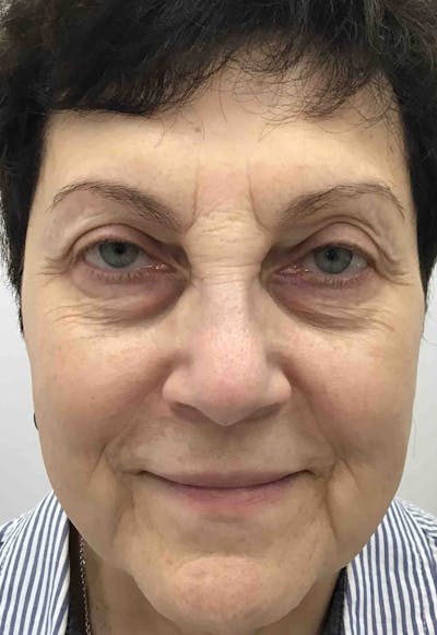 Liquid Facelift Before & After Gallery - Patient 374122 - Image 1