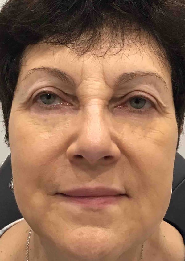 Liquid Facelift Before & After Gallery - Patient 374122 - Image 2