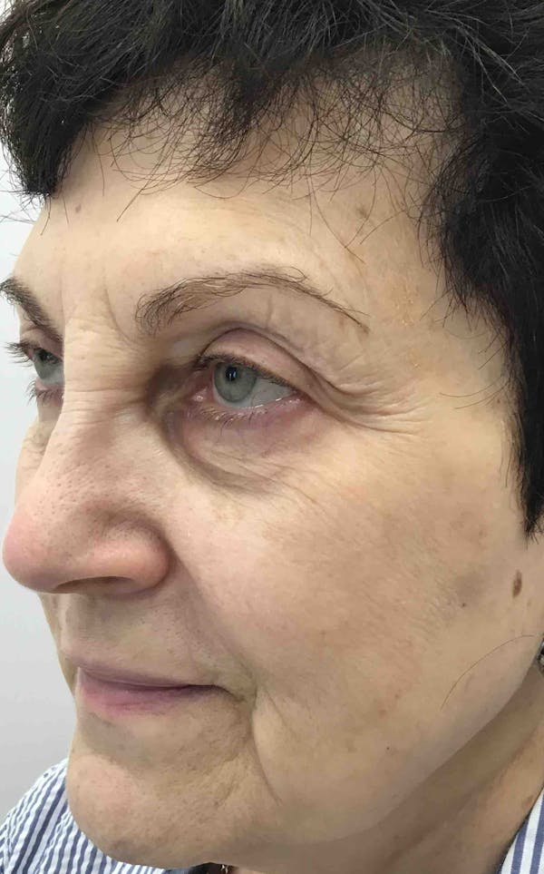 Liquid Facelift Before & After Gallery - Patient 374122 - Image 3