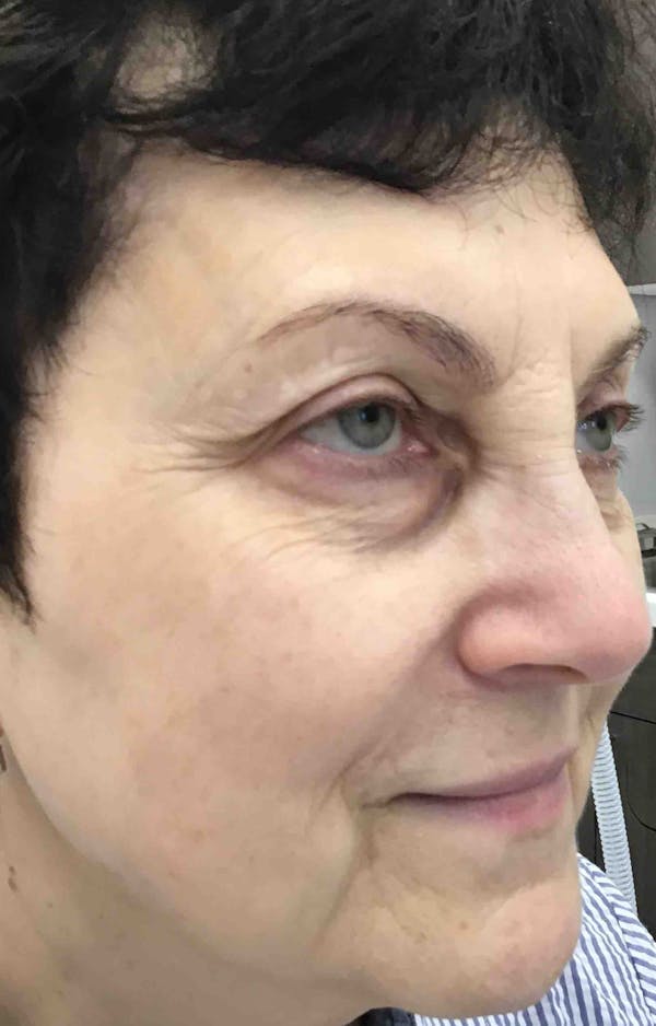 Liquid Facelift Before & After Gallery - Patient 374122 - Image 5