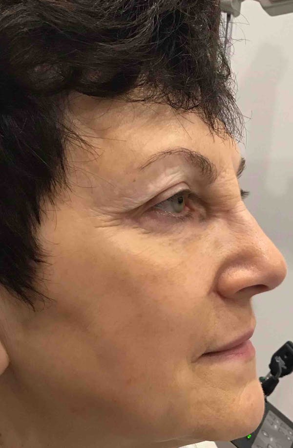 Liquid Facelift Before & After Gallery - Patient 374122 - Image 6