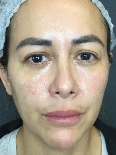 Liquid Facelift Before & After Gallery - Patient 306783 - Image 1