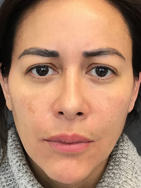 Liquid Facelift Before & After Gallery - Patient 306783 - Image 2