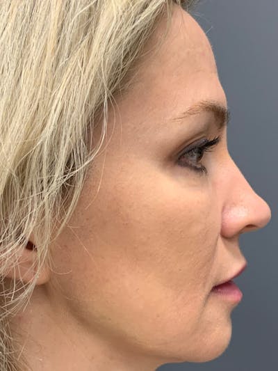 Fillers Before & After Gallery - Patient 106331 - Image 8