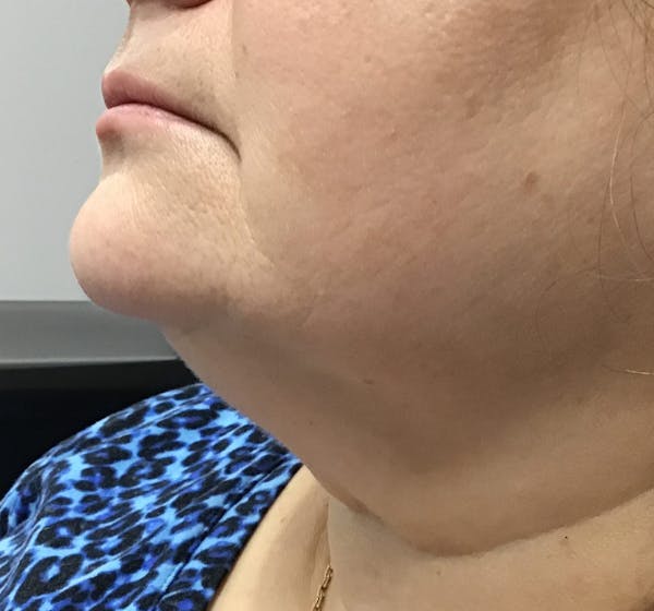 Kybella Before & After Gallery - Patient 375278 - Image 1