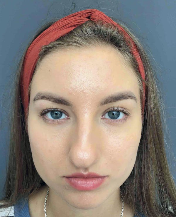 Fillers Before & After Gallery - Patient 172650 - Image 1