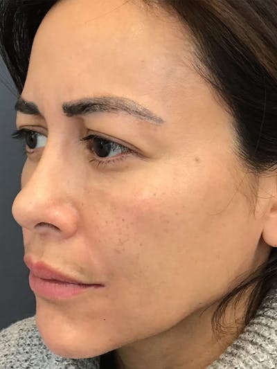 Liquid Facelift Before & After Gallery - Patient 306783 - Image 6