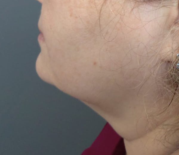 Kybella Before & After Gallery - Patient 375278 - Image 2