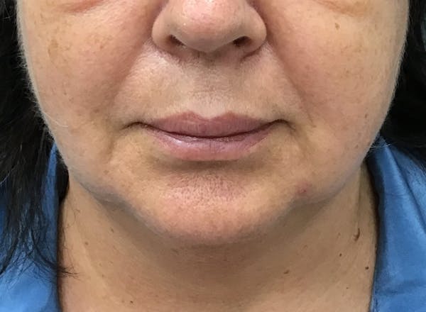 Kybella Before & After Gallery - Patient 375278 - Image 3