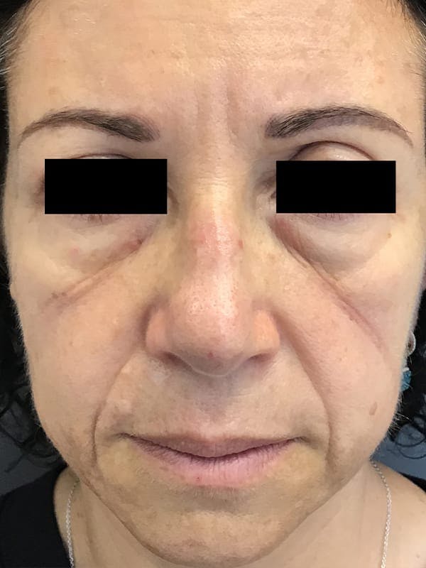 Liquid Facelift Before & After Gallery - Patient 685305 - Image 1