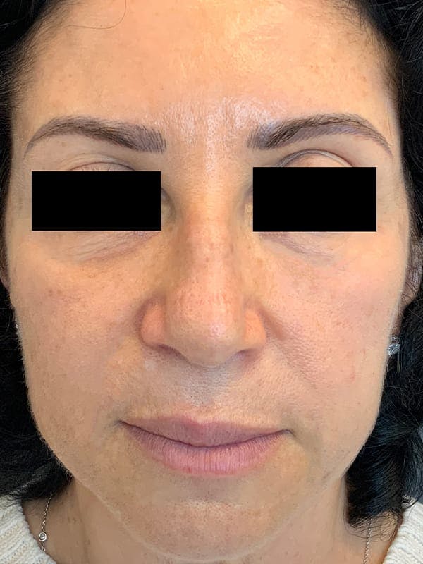 Liquid Facelift Before & After Gallery - Patient 685305 - Image 2