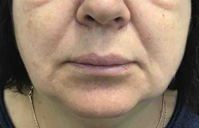 Kybella Before & After Gallery - Patient 375278 - Image 4