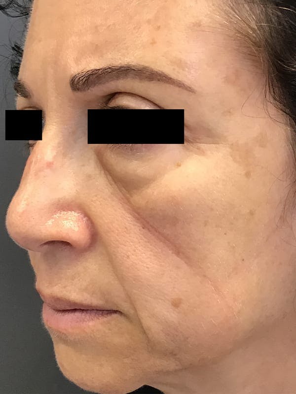 Liquid Facelift Before & After Gallery - Patient 685305 - Image 3
