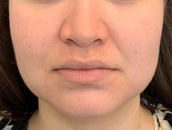 Kybella Before & After Gallery - Patient 209650 - Image 7