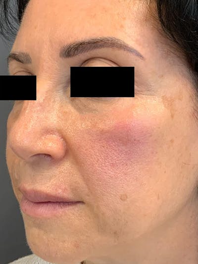 Liquid Facelift Before & After Gallery - Patient 685305 - Image 4