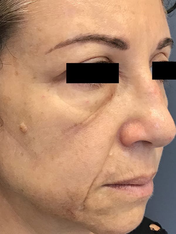 Liquid Facelift Before & After Gallery - Patient 685305 - Image 5