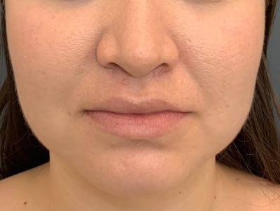 Kybella Before & After Gallery - Patient 209650 - Image 8
