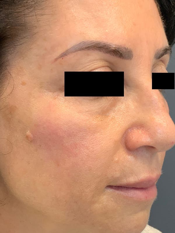 Liquid Facelift Before & After Gallery - Patient 685305 - Image 6